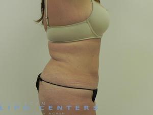 americanlipocenters_173.jpg